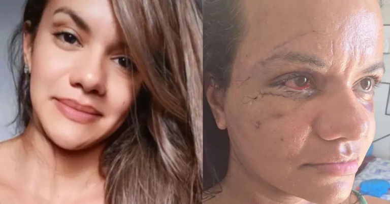 Mulher desfigurada ao levar 61 socos do namorado mostra rosto após reconstrução facial
