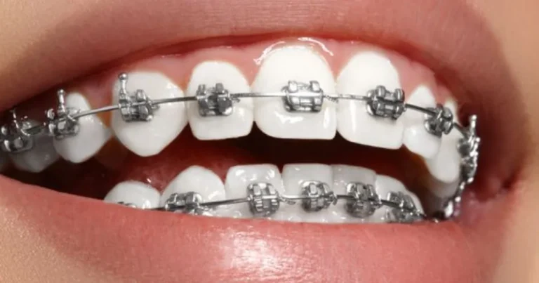Aparelhos de correção dentária falsos podem causar danos à saúde, alerta CFO