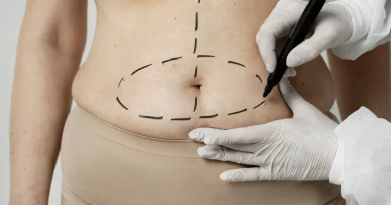 Cirurgia plástica: especialista indica técnicas modernas no aumento dos glúteos