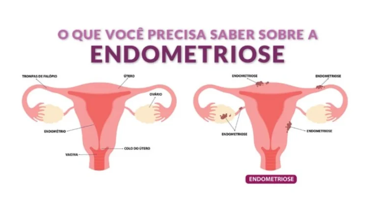 Fabiana de Lemos | Endometriose: uma doença com instalação silenciosa