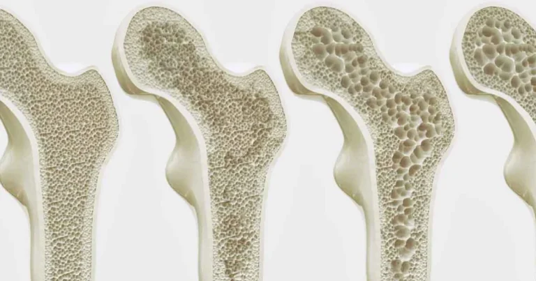 Como funciona técnica inovadora que pode reverter progressão da osteoporose